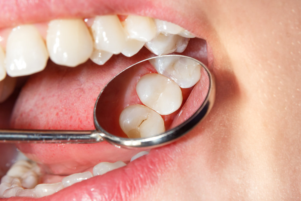 Dental treatment in the dental clinic. Rotten carious tooth close-up macro. Treatment of endodontic canals