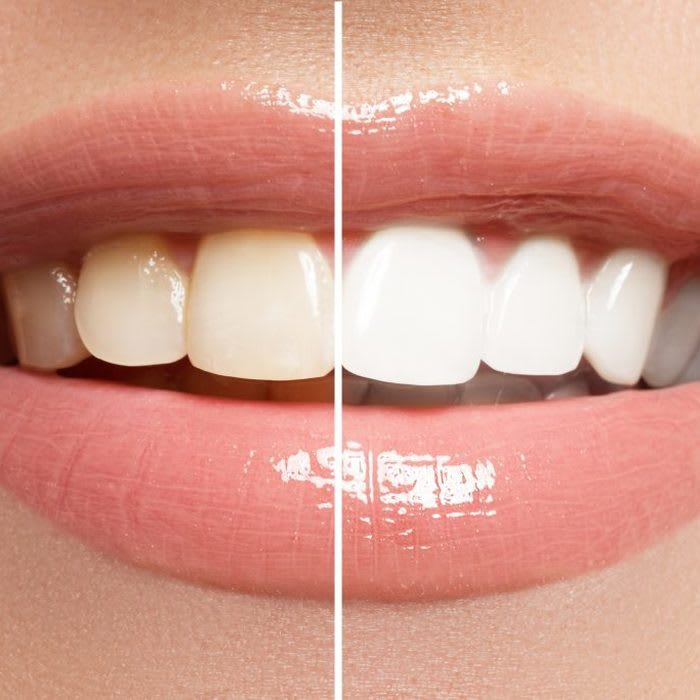 teeth-whitening